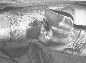 Fig. 5 One case with folliculitis around the sampled donor site.