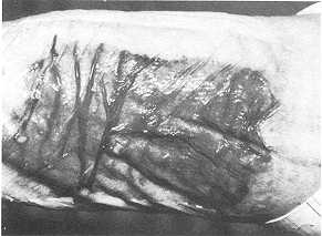 Fig. 6 In one case, it was necessary to keep the plaque for 2 1 days, because the donor site for a cross leg flap was under a splint.