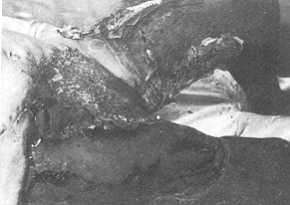 Fig. 2 Femorogluteal injury, transplant in the consolidation period (the donor site in the left femoral region).