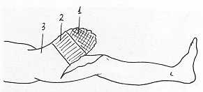 Fig. 3 Avulsed flap in femoral region.