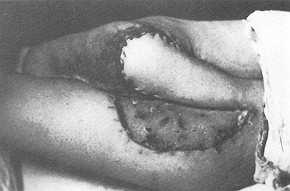 Fig. 3 Le transfert du lambeau musculo-cutan de gastrocnemius du ct oppos a combl un defaut  la fce postrieure calcanaire.