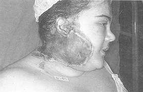 Fig. 2a Contact burn by hot iron. Appearance on admission.  