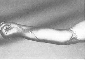 Fig. 2 Résultat fonctionnel aprés transfert libre musculo-cutané (lambeau de grand dorsal) réinnervé par le nerí` inter-osseux antérieur.