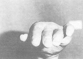 Fig. 1 Hypertextension de la métacarpophalangienne du V¿me doigt.