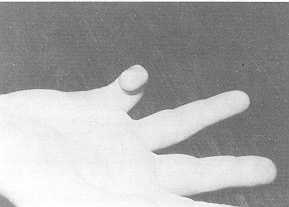 Fig. 2 Bride cubitale latérale, flexum de l'interphalangienne proximale et de l'interphalangienne distale, abduction de la métacarpophalangienne.