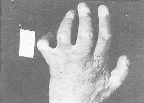 Fig. 3 Ddormation complexe du Veme doigt avec rotation, abduction et hyperextension de la métacarpophalangienne rnalgré une greffe dorsale.