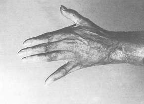 Fig. 4 A) Sequelles pré-opératoires, bride laterate, abduction du Wrne doigt (vue dorsale);