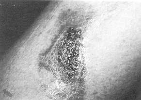Fig. 1 35-year-old woman with scald burn on left lower limb. 