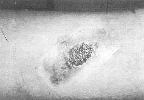 1 b) Wound after 15 days: size of bum markedly reduced.