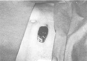 Fig. 2 12-year-old boy with fire burn on abdomen. 