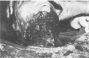 Fig. 3 B. Rsultat a 18 mois aprs excision des chldides.