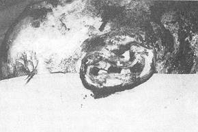Fig. 2 Chondrectornie partielle au niveau de Fanthélix et de la conque.