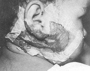 Fig. 1.    3 days post application of Omiderm to second-degree facial bum.
