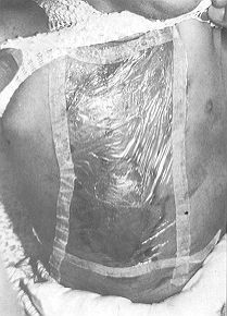 Fig. 2 Onviderm on second-degree chest bum..