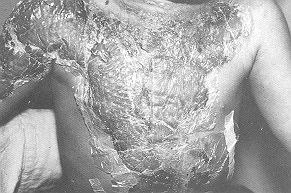 Fig. 5 Omiderm and crusts on 10-days bum peeling off with thorough soaking offly.