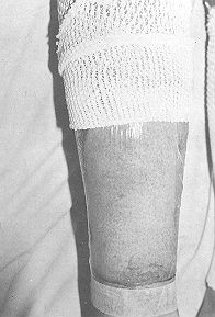 Fig. 4 Bandafix and tape, holding Omiderm in place on a limb bum.