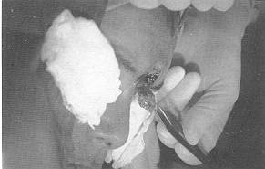 Fig. 2 Surgical removal of the eschar