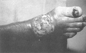 Fig. 6 Contact burn. Thirty days of evolution in other hospital.