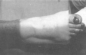 Fig. 7 Application of carboxymethycellulose sheet
