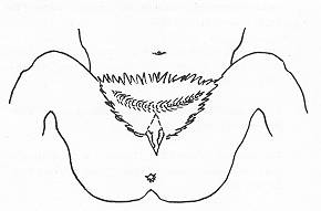 Fig. 1 The localisation of the contracture involving some entire regions.