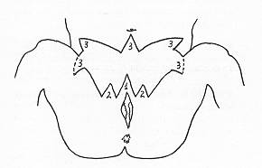 Fig. 2 The position of angles and triangles with the aim of releasing the contracture and eliminating the retractive forces.