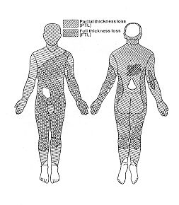 Fig. 1 - Distribution of partial- and full-thickness bum areas.