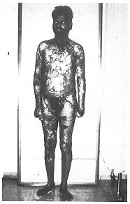 Fig. 2 - Patient 6 months after discharge: anterior and posterior views.