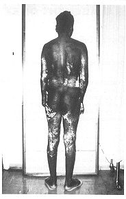 Fig. 2 - Patient 6 months after discharge: anterior and posterior views.