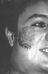Fig. 1A - Expander located in mandibular region in 17-year-old girl presenting a burn in the cheek area.