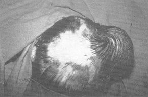Fig. 2A - Post-burn alopecia and expander over the parietooccipital region in 5-year-old boy.