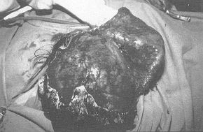 Fig. 2B - The alopecia area rerrioved and the flap raised.