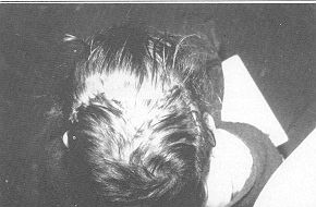 Fig. 2C - Early post-operative result.