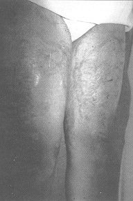 Fig. 3A - Burn scArs over both. thighs in 19-year-old girl.