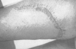 Fig. 3B - Right thigh with the expancler.