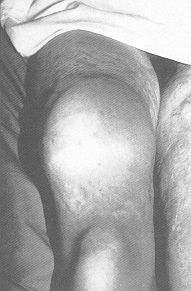 Fig. 3C - Early post-operative resuit, right thigh.