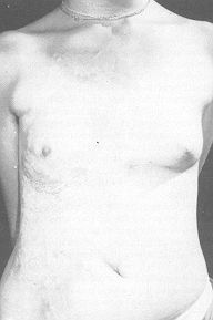 Fig. 4A - Large post-burn scar in trunk of 15-year-old girl.