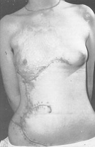 Fig. 4C - Early post-operative result, pending right breast construction.