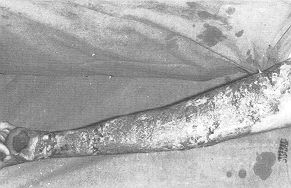 Fig. 7 - Homme g (le 67 ans avec 15% de brlure profonde sur la jambe droite.