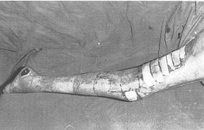 iFig. 8 - Le mme patient aprs 2 interventions chirurgicales, La jambe est couverte de grandes autogreffes et les lsions sur la cuisse par des homogreffes.
