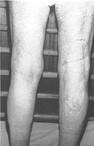 Fig. 9 - Le mme patient aprs 2 ans.