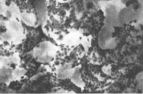 Fig. 1 - Four-day-old colonies of keratinocytes growing on cell-free pig dermis. 3T3 cells were selectively washed off by trypsin.