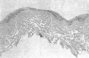 Fig. 2 - Vertical section of RHI'S composed of a keratinocyte layer '-rowing on cell-frce pig dermis.