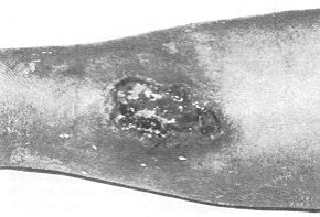 Fig. 5a - Case 1. Leg ulcer before treatment with RHPS.