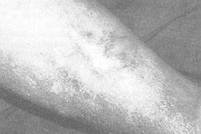 Fig. 5b - Case 1. 6 months after R14PS aj)plication. The ulcer heal-ed in two weeks and remained stable.