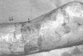 Fig. 6a - Case 3. RHPS-treated burn area: a) 5 days after RHPS al)piication (4), xenografted area (44).