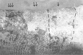 Fig. 6b - Case 3. RHPS-treated bum area: b) 12 days after RHPS application (1), autografted area (4), as yet unhealed area - meshed autografts (~4).