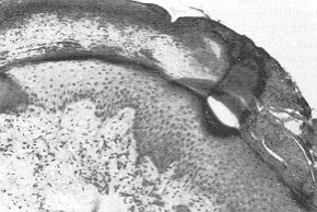 Fig. 7a - Vertical section of histological sample taken from RWStreated area 7 days post-application: a) healed young epidermis covered by a layer of RHPS.