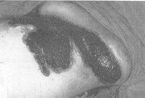 Fig. 2 - Pre-operative aspect after cleansing (23 days after injury).