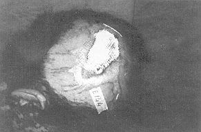 Fig. 2a - Necrosis due to electrocution of scalp.