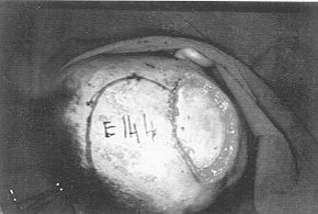 Fig. 2b - Exposure, after escharectomy, of cranium; design of rotation flap performed on day 15.